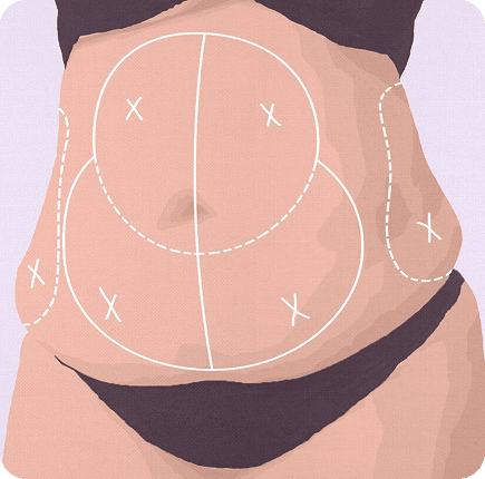 image of Abdominoplasty