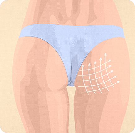 image of Gluteal Augmentation