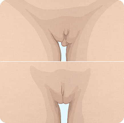 image of Labiaplasty