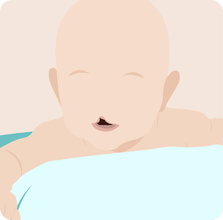 image of Cleft Lip and Palate Repair