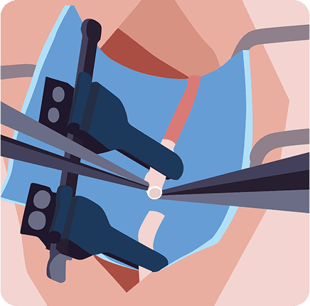 image of Microsurgery and Free Tissue Transfer