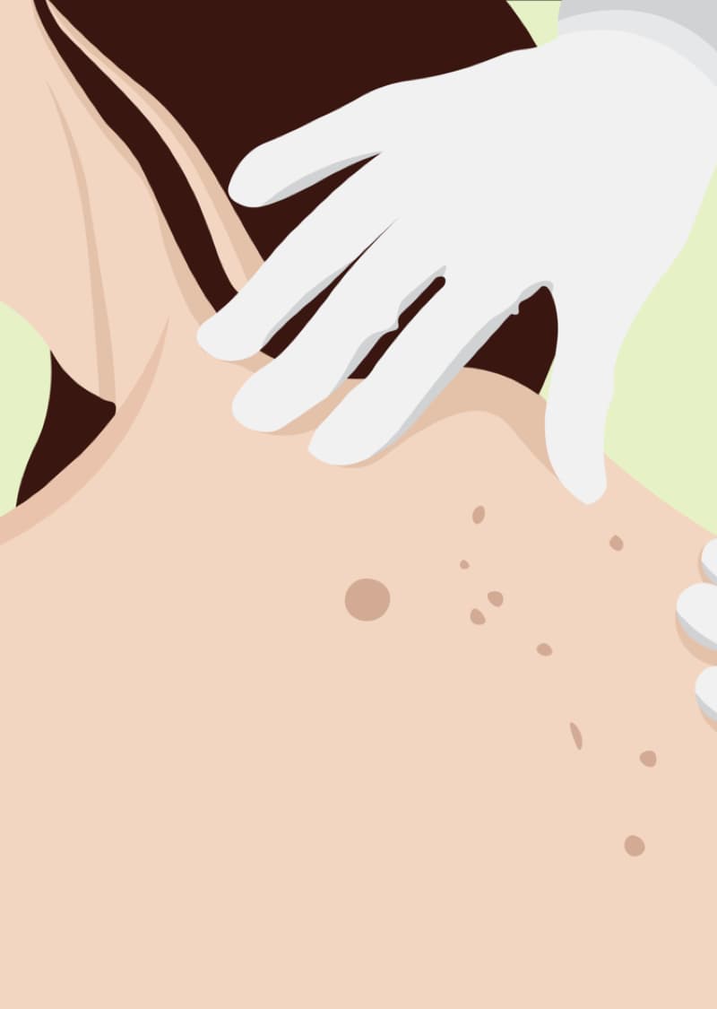 Skin Cancer